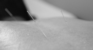 Acupuntura